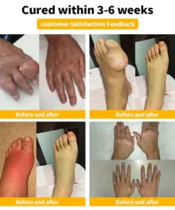 Flysmus™ Bee Venom Pain-Relief Bone Healing Cream