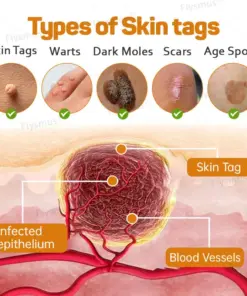 Flysmus® Tag Recede Bee Venom Treatment Cream