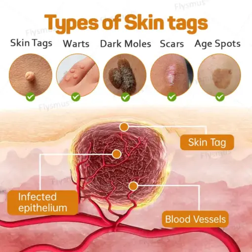 Flysmus® Tag Recede Bee Venom Treatment Cream