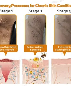 Flysmus® Tag Recede Bee Venom Treatment Cream