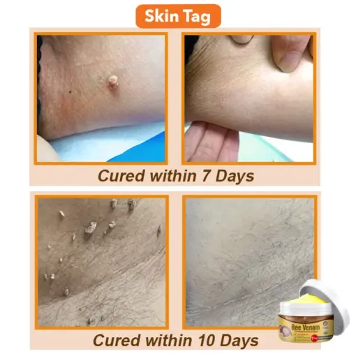 flysmus® Bee Venom Comprehensive Cream
