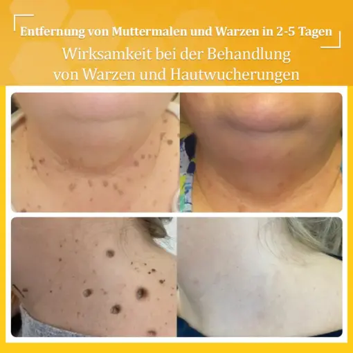 flysmus™ Starke Bienenvergiftungs-Reparaturcreme