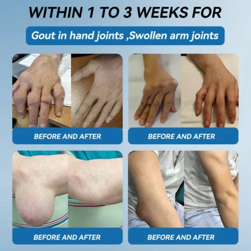 𝐟𝐥𝐲𝐬𝐦𝐮𝐬® 𝐁𝐏𝐂-𝟏𝟓𝟕 𝐉𝐨𝐢𝐧𝐭 𝐇𝐞𝐚𝐥𝐢𝐧𝐠 𝐂𝐫𝐞𝐚𝐦