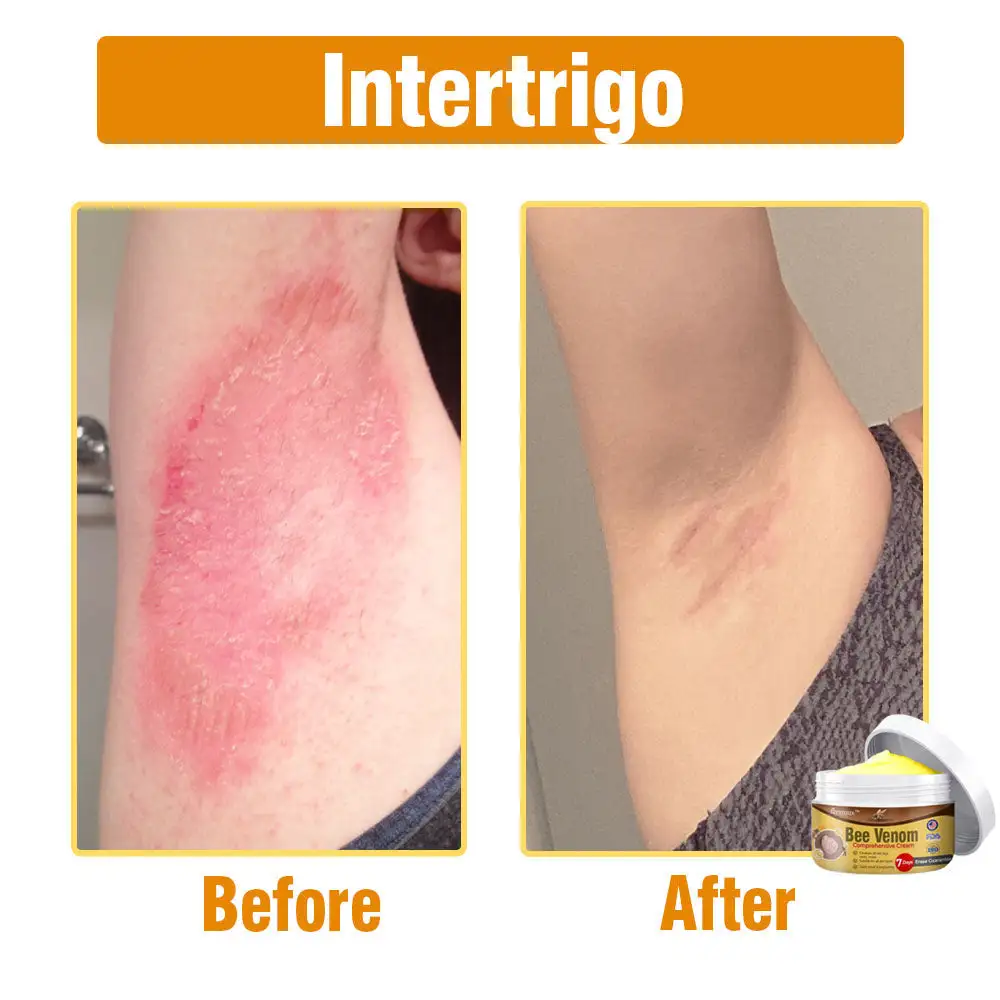 flysmus® Bee Venom Comprehensive Cream Made in UK