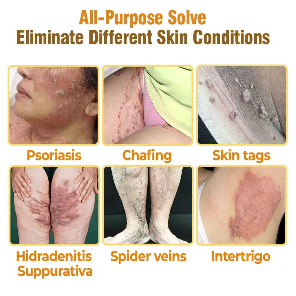 flysmus® Bee Venom Comprehensive Cream Made in UK